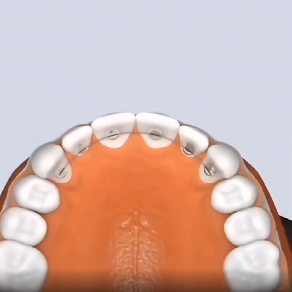 2 Pcs Dental Orthodontic Universal Lingual Retainers Mesh Base Bonding Splints Odontologia Material Dentista